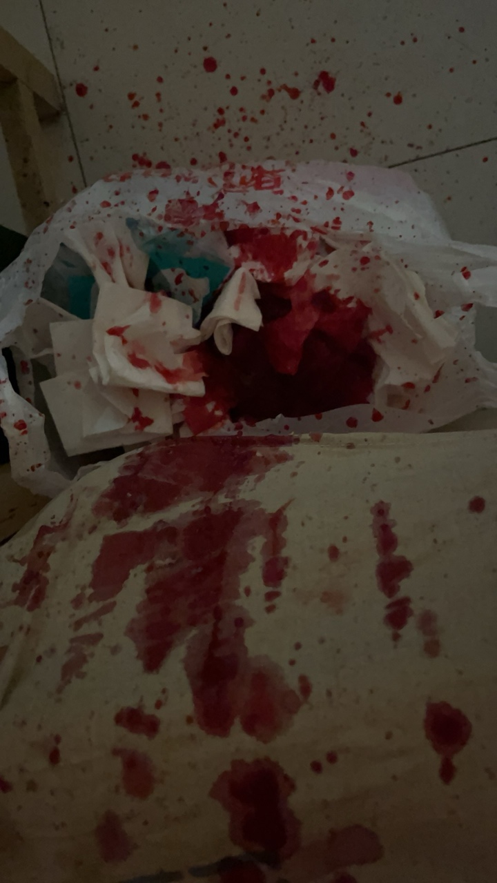 本来停药一周，想等s了，但是又感觉等硬化腹水身体也难受，继续吃药多活两年吧

12 / 作者:我爱菲菲 / 